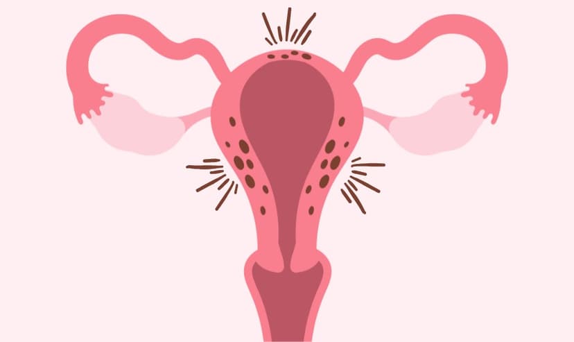 L’Adénomyose Utérine : Comprendre pour mieux vivre